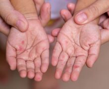 Șapte persoane s-au îmbolnăvit de rujeolă de la începutul anului 2025